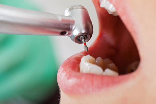 Best Chipped Tooth Repair Near Me  in Shinnston, WV